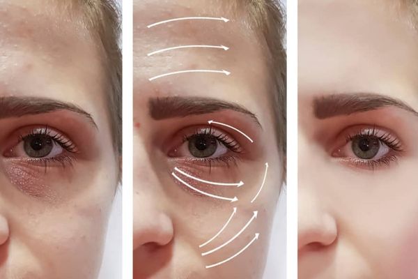 Anti Wrinkles treatment