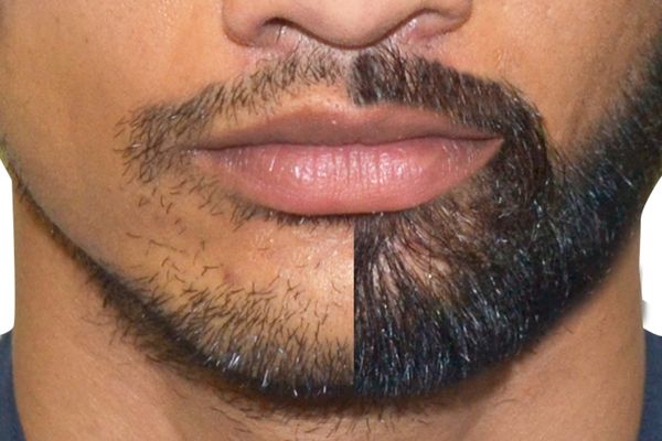 Beard Transplantation