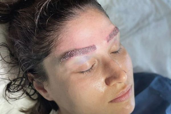 Eyebrow Transplantation
