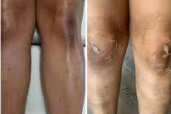 Full body peels