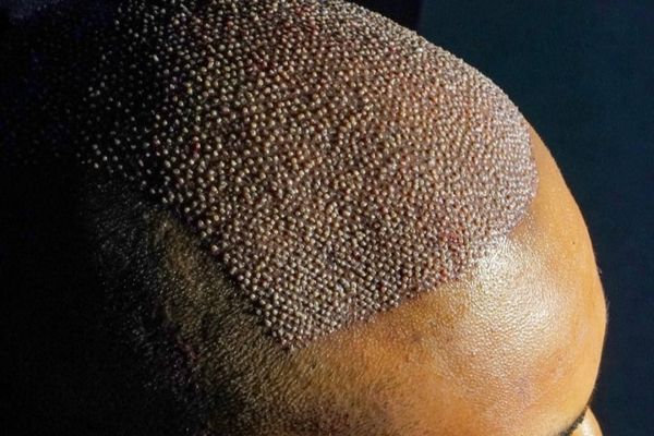 Hair Transplantation