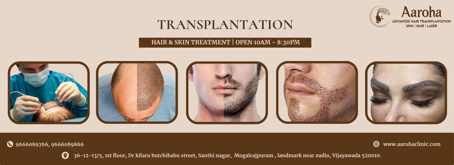 Hair transplant