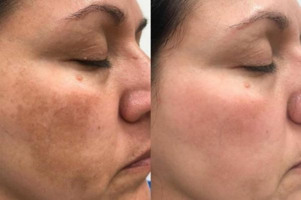 Melasma