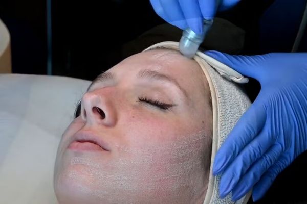 Microdermabrasion