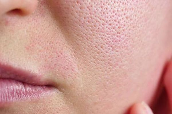 Open pores Reduction