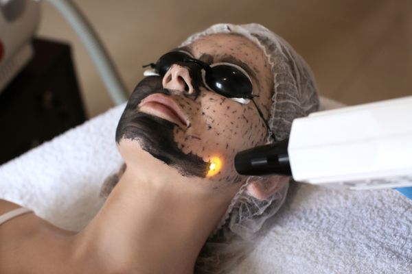 Photofacial / carbon laser