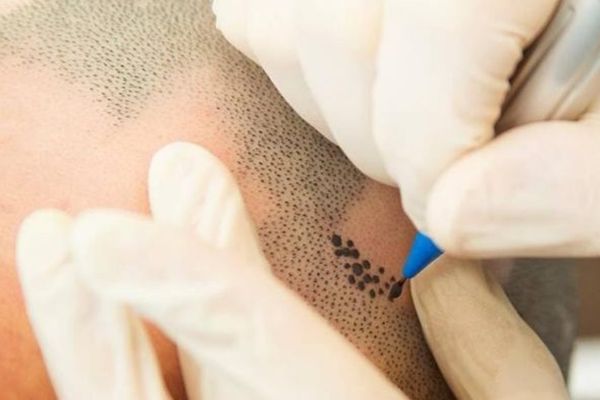 Scalp Micropigmentation