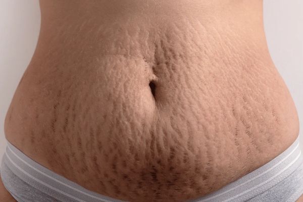 Stretch Mark Removal