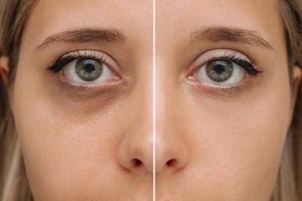 Under-eye Dark Circle treatment