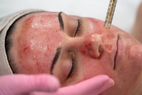 Vampire Facial Treatment